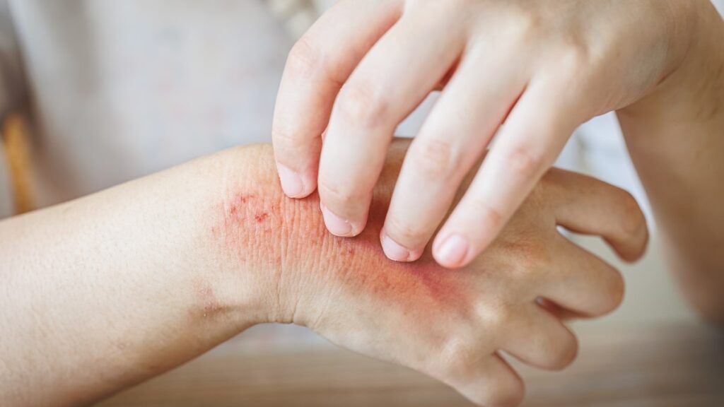 Frequent Bites or Rashes on Your Body